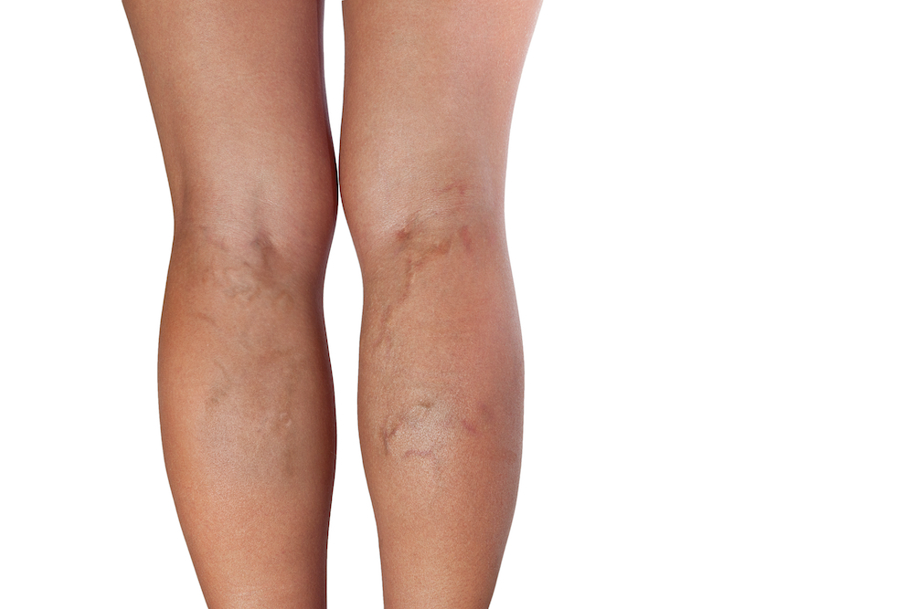 Varicose veins increase with age